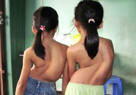 Cong vẹo cột sống